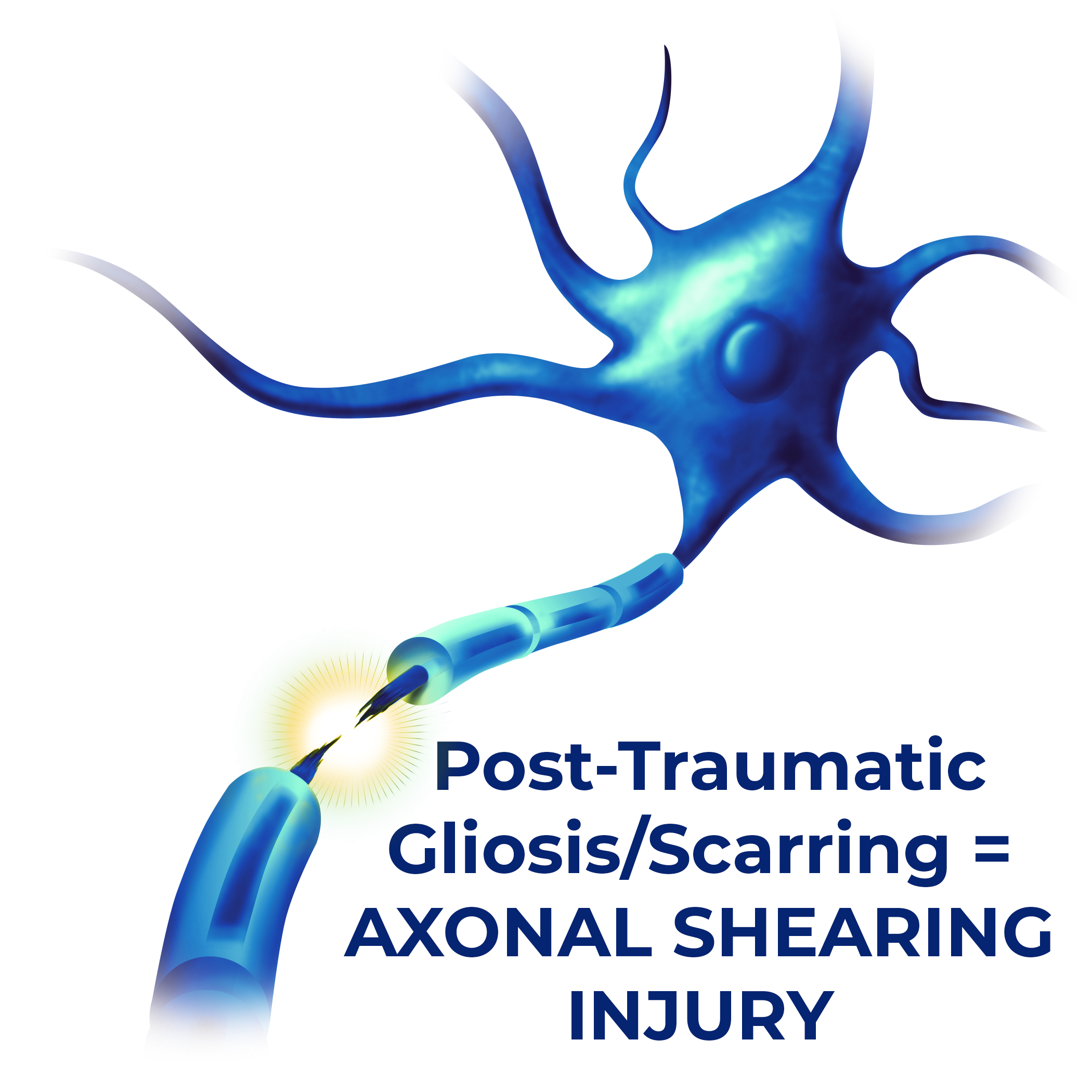 Gliosis Scarring Axonal Shearing Injury