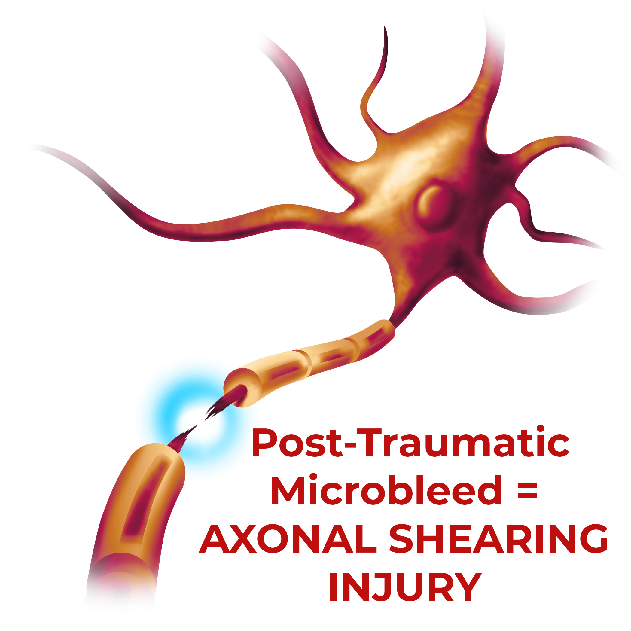 Microbleed Axonal Shearing Injury